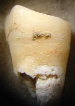 Calculus on ancient tooth (neolithic)